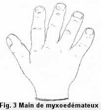 Figue 3: Main de myxœdémateux. Les doigts sont volumineux.